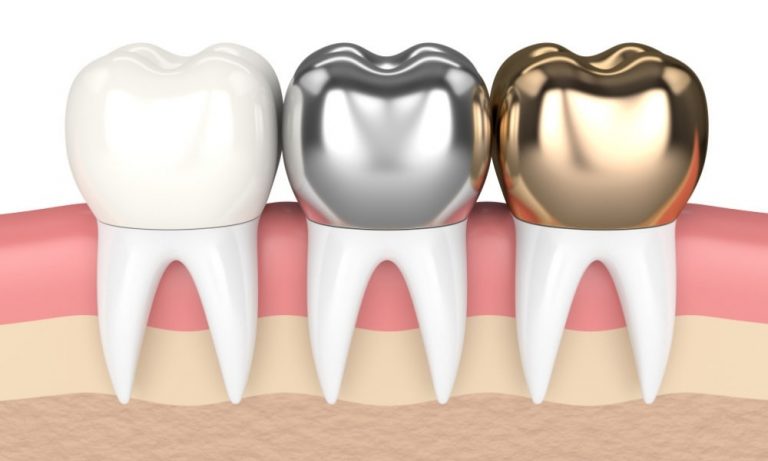 dental crowns implants